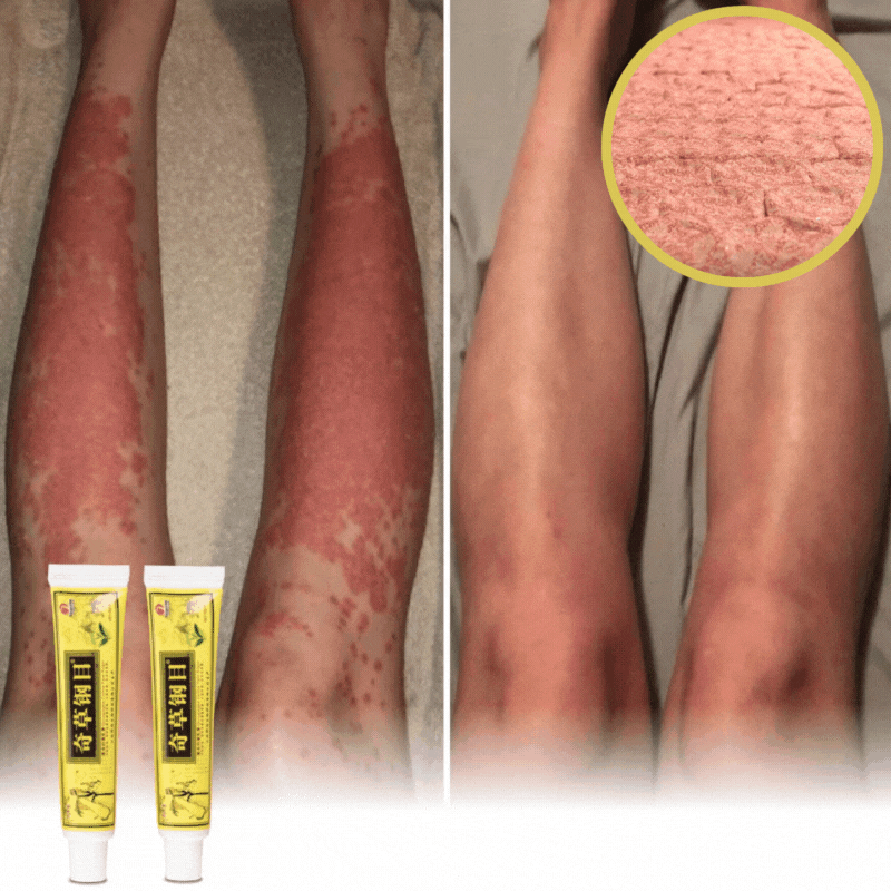 DermRelief™ | Zalfcrème voor Eczeem